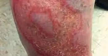 Necrobiosis lipoídica diabética