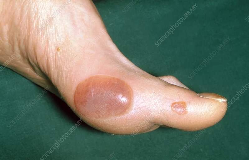 Ampollas diabéticas (Bullosis diabeticorum)